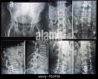 X-ray Bilder eines menschlichen Becken und Wirbelsäule Stockfoto