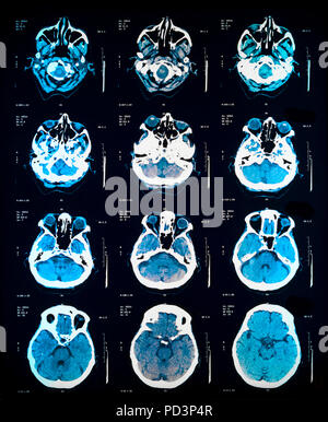 Reihenfolge der horizontale Abschnitte eines weiblichen menschlichen Gehirn, MRI-Scans, Magnetresonanztomographie, Stockfoto