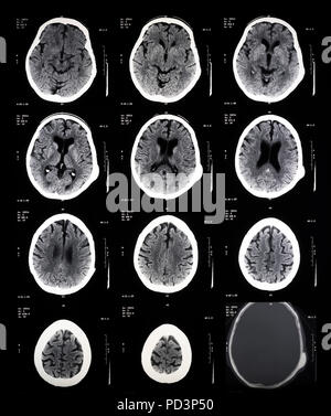 Reihenfolge der horizontale Abschnitte eines weiblichen menschlichen Gehirn, MRI-Scans, Magnetresonanztomographie, Stockfoto