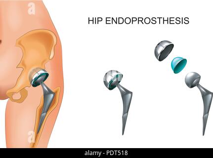 Vector Illustration der weiblichen Hüfte und Hüftprothese. Chirurgie. Stock Vektor