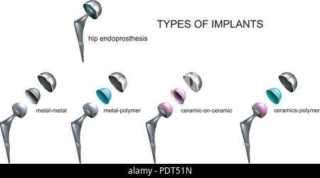 Vector Illustration der Typen von Implantaten durch die Art des Materials, Stock Vektor