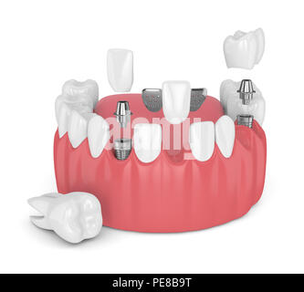 3D-Render von Kiefer mit dentalen Implantaten und Brücken über weißen Hintergrund Stockfoto