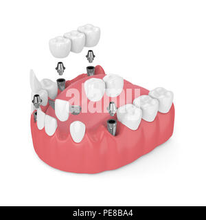 3D-Render von Kiefer mit dentalen Implantaten und Brücken über weißen Hintergrund Stockfoto