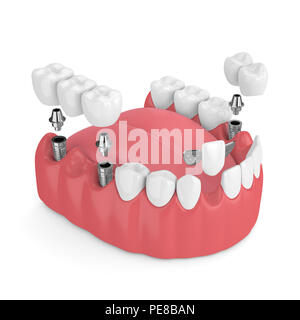 3D-Render von Kiefer mit dentalen Implantaten und Brücken über weißen Hintergrund Stockfoto