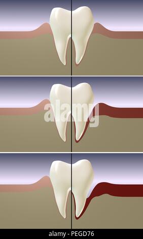 Parodontitis, Gingivitis und Zahnfleischentzündung 3D Rendering Illustration. Zahnpflege. Stockfoto