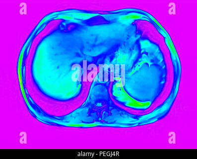 Querschnitt Abdomen MRI-Scan eines 60 Jahre alten männlichen Patienten. Dieser Patient leidet an einem nierenstein Stockfoto