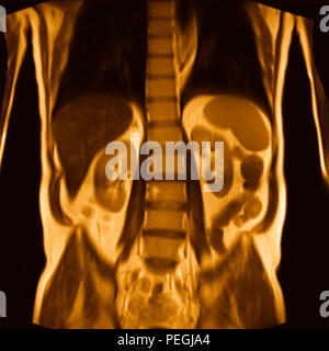 Vorderen Bauchwand MRI-Scan eines 60 Jahre alten männlichen Patienten. Dieser Patient leidet an einem nierenstein Stockfoto