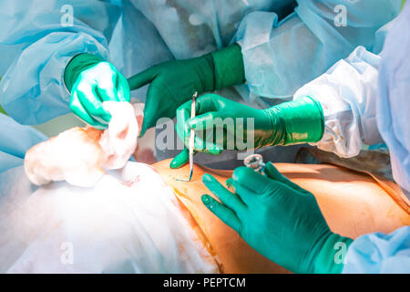 Kosmetische Fettabsaugung Chirurgie im eigentlichen Operationssaal, Gruppe der Operateure mit Kanüle Stockfoto