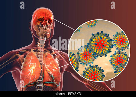 Computer Illustrationen mit dem Gemeinsamen Komplikationen einer Maserninfektion, wie Enzephalitis und Lungenentzündung. Stockfoto