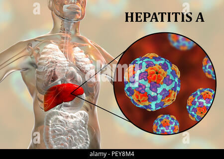 Hepatitis-B-Infektion. Computer Abbildung Mit Der Leber Und Eine ...