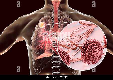 Aspergilloma der Lunge und eine Nahaufnahme von Aspergillus Pilze, computer Abbildung. Auch als myzetom oder Pilz ball bekannt, ist dies ein intrapulmonary Läsion durch Aspergillus Pilze bei immunsupprimierten Patienten hergestellt. Stockfoto