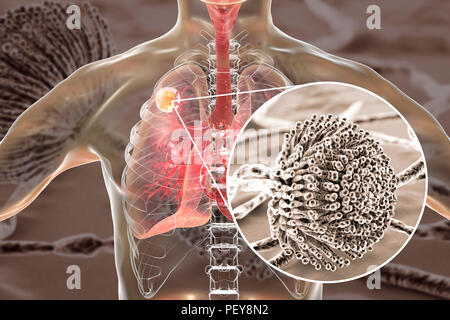 Aspergilloma der Lunge und eine Nahaufnahme von Aspergillus Pilze, computer Abbildung. Auch als myzetom oder Pilz ball bekannt, ist dies ein intrapulmonary Läsion durch Aspergillus Pilze bei immunsupprimierten Patienten hergestellt. Stockfoto