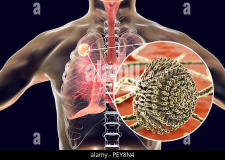 Aspergilloma der Lunge und eine Nahaufnahme von Aspergillus Pilze, computer Abbildung. Auch als myzetom oder Pilz ball bekannt, ist dies ein intrapulmonary Läsion durch Aspergillus Pilze bei immunsupprimierten Patienten hergestellt. Stockfoto