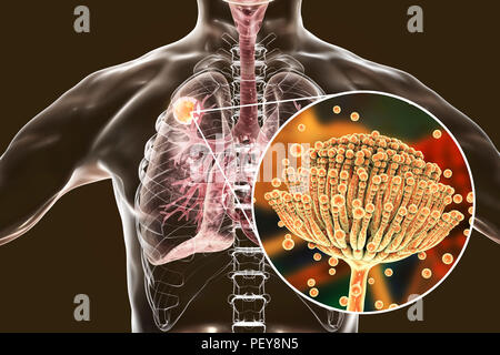 Aspergilloma der Lunge und eine Nahaufnahme von Aspergillus Pilze, computer Abbildung. Auch als myzetom oder Pilz ball bekannt, ist dies ein intrapulmonary Läsion durch Aspergillus Pilze bei immunsupprimierten Patienten hergestellt. Stockfoto