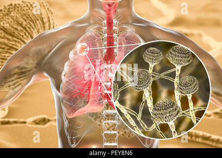 Aspergilloma der Lunge und eine Nahaufnahme von Aspergillus Pilze, computer Abbildung. Auch als myzetom oder Pilz ball bekannt, ist dies ein intrapulmonary Läsion durch Aspergillus Pilze bei immunsupprimierten Patienten hergestellt. Stockfoto