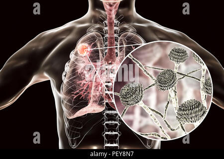 Aspergilloma der Lunge und eine Nahaufnahme von Aspergillus Pilze, computer Abbildung. Auch als myzetom oder Pilz ball bekannt, ist dies ein intrapulmonary Läsion durch Aspergillus Pilze bei immunsupprimierten Patienten hergestellt. Stockfoto