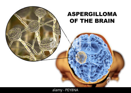 Aspergilloma des Gehirns und eine Nahaufnahme von Aspergillus Pilze, computer Abbildung. Auch als myzetom oder Pilz ball bekannt, dies ist eine intrakranielle Läsion durch Aspergillus Pilze bei immunsupprimierten Patienten hergestellt. Stockfoto