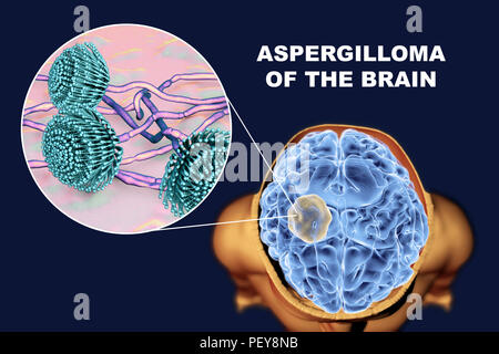 Aspergilloma des Gehirns und eine Nahaufnahme von Aspergillus Pilze, computer Abbildung. Auch als myzetom oder Pilz ball bekannt, dies ist eine intrakranielle Läsion durch Aspergillus Pilze bei immunsupprimierten Patienten hergestellt. Stockfoto