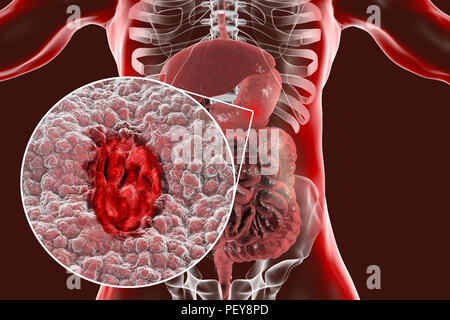 (Magen) Magengeschwür, Abbildung. Magen- oder Verdauungs-, Geschwüre sind Erosionen der Schleimhaut des Magens. Stockfoto
