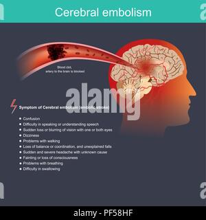 Es tritt auf, wenn ein Teilchen von einem Teil des Körpers durch den Blutkreislauf zum Gehirn reist und blockiert den Blutfluss in einer Arterie im Gehirn Stock Vektor