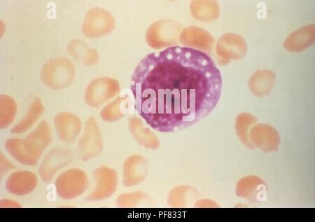 Atypische erweiterten Lymphozyten im Blut verschmiert Schliffbild aus einem HPS Patienten, 1994 aufgedeckt. Mit freundlicher Seuchenkontrollzentren (CDC). () Stockfoto