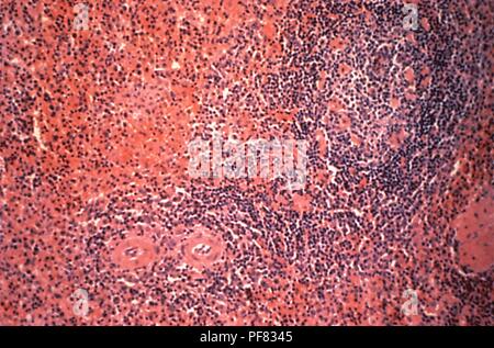 Milz Gewebe in das schliffbild Bild aus einem Hantavirus pulmonary Syndrome (HPS) Patienten, 1994 aufgedeckt. Mit freundlicher Seuchenkontrollzentren (CDC). () Stockfoto