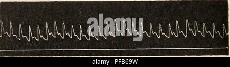 . Wörterbuch de Physiologie. Physiologie. Abb. 14. Â (D'Après-ski A. Binet et Höfling) Abb. 15. Â (D'Après-ski A. Binet et Höfling) Pouls radial sthÃ © NIQUE. Pouls radial asthÃ © NIQUE. l'©lÃ©ration accÃ du cÅur et de la Respiration. Ce qui est tout À fait caractÃ©ristique, c'est l'abaissement et l'Akzentuierung du dicrotisme. Le zweite groupe d'Übungen muscu - laires Seife des Übungen locaux (pression au dynamomÃ¨Tre, Bemühungen de Position, faradisation, etc.), qui durent peu de temps et amÃ¨nent À leur Suite une Müdigkeit pro-Fonde. Le cÅur, la Respiration sind accÃ © lÃ© rÃ©s, Mais beaucoup * q Stockfoto