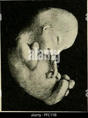 "Eine Studie über die Ursachen der Ursprung des menschlichen Monster: dritter Beitrag zur Untersuchung der Pathologie des menschlichen Embryos" (1908) Stockfoto