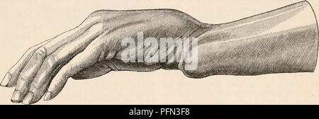 . Die cyclopaedia von Anatomie und Physiologie. Anatomie, Physiologie, Zoologie. Handgelenk - GEMEINSAME (Anatomie), 1517 den Unterarm. Das Handgelenk brach und wurde sofort verformt. Die dissektion Re- vealed Eine einfache und quer Fraktur des carpal Extremität des Radius, mit einem dis-Position rückwärts von der unteren Fragment, wie mit gewöhnlichen Fällen der Fraktur des Radius in der Nähe des Handgelenks - Gemeinsame, eine Art von Verletzung, die in dieser Stadt mit dem Namen "koliken" Bruch bekannt ist." Es würde auch zu Malgaigne, Bouchet, und Voillemier angezeigt, dass dieser Bruch kann b Stockfoto