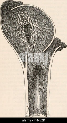 . Die cyclopaedia von Anatomie und Physiologie. Anatomie, Physiologie, Zoologie. 602 ANORMALE BEDINGUNGEN DES SCHULTERGELENKS. vollständig untersucht. Der Arm war etwas kurz - ened. Die Kontur der Schulter war nicht so voll, noch als Runde wie die seines Kollegen und das schulterdach Prozess wurde mehr im Vordergrund als das Natürliche. Beim Öffnen der kapselfibrose Ligament, der Leiter des Humerus wurde gefunden in der cancellated tis angetrieben worden zu sein - der Welle Sue, zwischen dem tuberosities, so tief wie unterhalb des Gipfels des großen tuberkel werden; dieser Prozess hatte aufgeteilt worden und Vertriebenen nach außen; es für Stockfoto