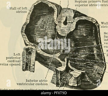 . Cunninghams Lehrbuch der Anatomie. Anatomie. 1034 Die VASCULAE SYSTEM. Die Perforationen schließlich verschmelzen die sekundäre Foramen ovale der atrialen Septum zu bilden. Sobald das Septum primum abgeschlossen ist, ist das primitive Atrium ist in der Ständigen rechts und links Atrien aufgeteilt, von denen jeder kommuniziert über die sekundäre Foramen ovale, mit dem Atrium des linken Teils der atrio-ventrikulären Drossel Truncus arteriosus gegenüberliegenden Seite und mit dem Septum primum verschmilzt mit entsprechenden Teil des Ventrikels durch ein atrio-ventrikulären Aperture, die völlig separate Stockfoto