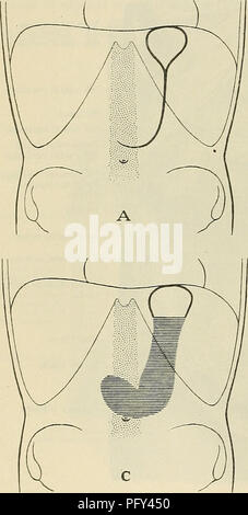 . Cunninghams Lehrbuch der Anatomie. Anatomie. 1172 DAS VERDAUUNGSSYSTEM. und rechts die Pylorus, das ist oft sehr oberflächlich unterhalb der Leber gelegt. Als Folge der Verschiebung, die linke Extremität der Bauchspeicheldrüse ist von der Horizontalen nach unten geschoben, bis es fast eine vertikale Position übernimmt. Die Verengung und Umkehrung der untere Rand der thorakalen Rahmen gleichzeitig engt die Magen über die Mitte und kann zu einem bilocular Zustand führen. Stunde - Glas oder Bilocular Magen..-Dies ist ein Zustand der Orgel, keine Seltenheit, in dem Der stom Stockfoto