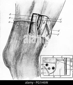 . Die chirurgische Anatomie des Pferdes... Pferde. B Platte XXV - anteriore Tibiale Neurectomy (Sitz absenken) A. - Der Sitz seziert I. Extensor pedis Muskel nach vorne angespannt. 2. Stütz- und kutane Nerv. 3. Flexor metatarsus Muskel. 4. Peroneus rückwärts mit Haltungs- und kutane Nerven angespannt. 5. Tiefe Faszien. 6. Tibialis Anterior liegen auf flexor Metatarsus. 7. Haut und super-ficial Faszien. B - der Sitz in Abschnitt I. Extensor pedis, z. Flexor Metatarsus. 3 und 6. Anterior tibial Venen. 4. Anterior tibial Arterie. 5. Tibia. 7. Peroneus Muskel. 8. Tiefe Faszien. 9. Tibialis Anterior. 10. Oberflächlichen faszie. Stockfoto