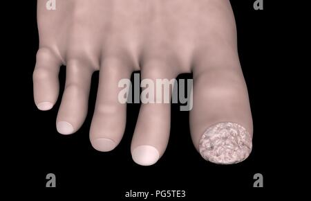 Zehe-nagel mit Pilzbefall. Vor der Behandlung. Infizierte Zehennagel. 3D-Render. Stockfoto