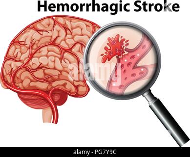 Eine menschliche Anatomie hämorrhagischen Schlaganfall Abbildung Stock Vektor