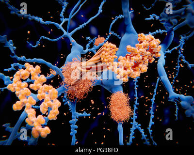 Beta-amyloid-Protein, das bei der Alzheimer-Krankheit. Abbildung der Prozesse, die zur Bildung von amyloiden Plaques (tangled Bundles) auf Neuronen (Nervenzellen, blau). Amyloid-plaques sind charakteristische Merkmale der Alzheimer Krankheit. Sie führen zu Degeneration der betroffenen Neuronen. Die zellulären Prozesse hier findet statt, nachdem die die Amyloid-beta-Peptid hat gespalten wurde von der Gamma und Beta Sekretasen. Die amyloid Rückstände hinterlässt die Zellmembran, ändert sich die Form und Aggregate in langen Fibrillen. Diese Fibrillen bilden dichte Plaketten auf Nervenzellen. Stockfoto