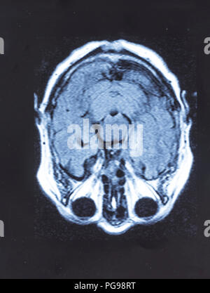 Menschliche Gehirn, Magnetresonanztomographie (MRT) scannen. Stockfoto