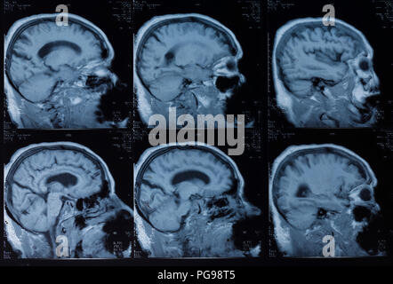 Menschliche Gehirn, Magnetresonanztomographie (MRT) untersucht. Stockfoto