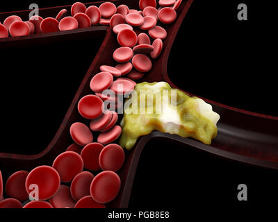 3 dIllustration der zerebralen Sklerose isoliert Schwarz. Stockfoto