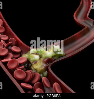 3 dIllustration der zerebralen Sklerose isoliert Schwarz. Stockfoto