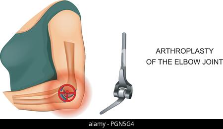 Vector Illustration der Endoprothetik des Ellbogengelenks Stock Vektor