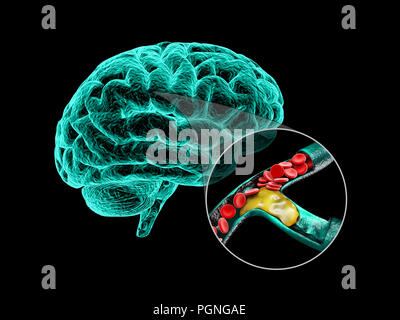 Menschliche Gehirn mit zerebraler Sklerose. Die menschliche Anatomie des Gehirns 3d-Abbildung. Stockfoto