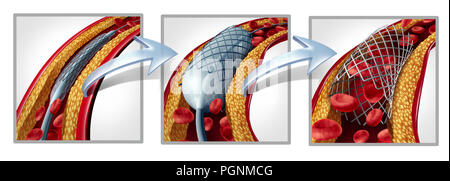 Koronare stent und angioplastie Konzept als Herzkrankheit Behandlung symbol Diagramm mit den Phasen eines Verfahrens Implantat in einer Arterie. Stockfoto