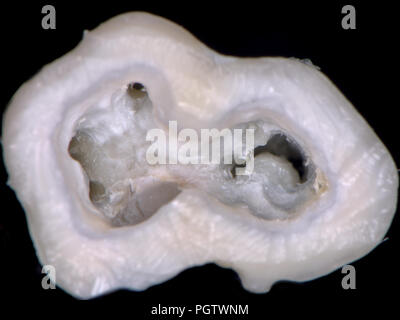 Weisheitszahn, linke untere Molaren, extra große, zwei Zahn in eine gemination, Fusion oder concrescentio? Stockfoto