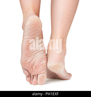Wunde Haut der Füße, Crack, chemische Fersen, Freistellungspfad Stockfoto