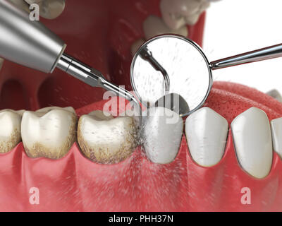 Professionelle Zahnreinigung. Ultraschall Zähne Reinigen der Maschine Zahnstein von menschlichen Zähnen zu löschen. 3D-Darstellung Stockfoto