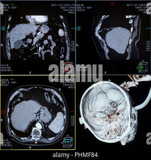 CT-Scans des menschlichen Kopfes Stockfoto