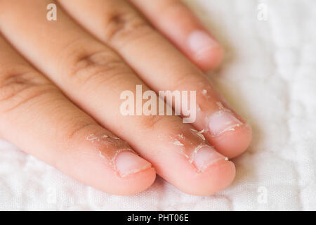 Nahaufnahme des Kindes Fingern, trockene Haut, Ekzem Dermatitis. Medizin und Gesundheit Konzept. Stockfoto