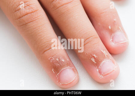 Nahaufnahme des Kindes Fingern, trockene Haut, Ekzem Dermatitis. Medizin und Gesundheit Konzept. Stockfoto