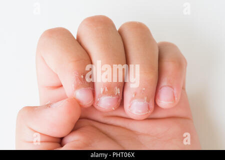 Nahaufnahme des Kindes Fingern, trockene Haut, Ekzem Dermatitis. Medizin und Gesundheit Konzept. Stockfoto